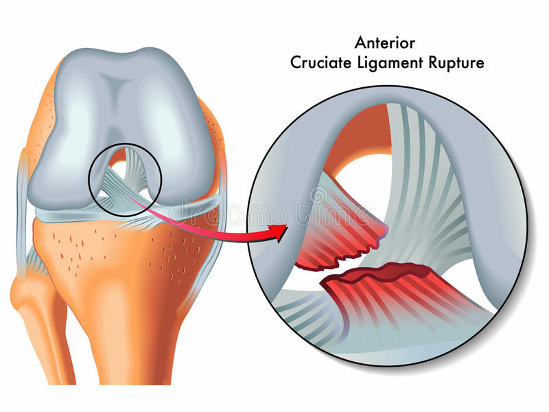 Common Knee Injuries: Exploring Ligament Injury - Phiten