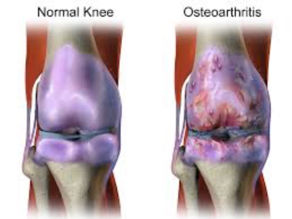 5 Common Types of Knee Injuries and Treatment - Costa Mesa Physical Therapy